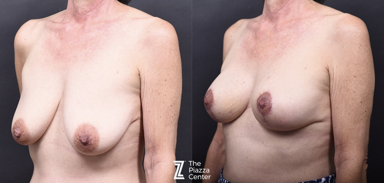 Austin Motiva Implants Before & After Gallery - Patient 883817 - Image 4 - The Piazza Center