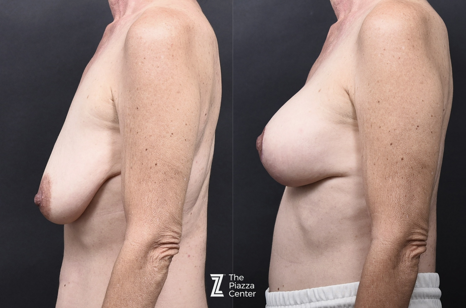 Austin Motiva Implants Before & After Gallery - Patient 883817 - Image 5 - The Piazza Center