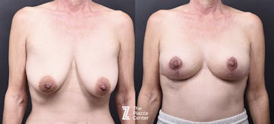 Austin Breast Augmentation Before & After Gallery - Patient 369861 - Image 1 - The Piazza Center
