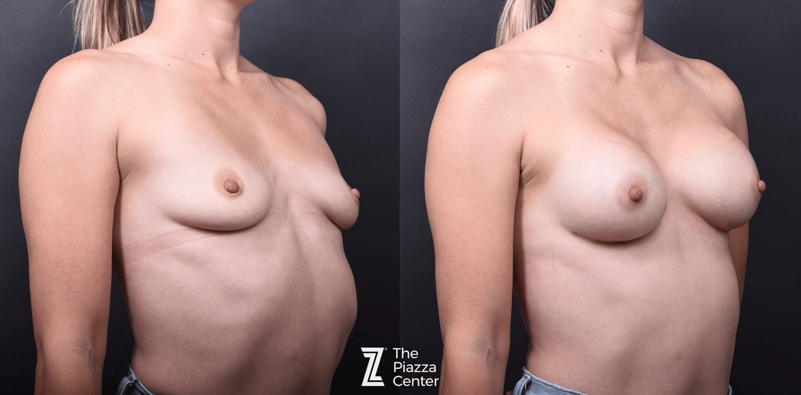 Austin Breast Augmentation Before & After Gallery - Patient 114776 - Image 2 - The Piazza Center
