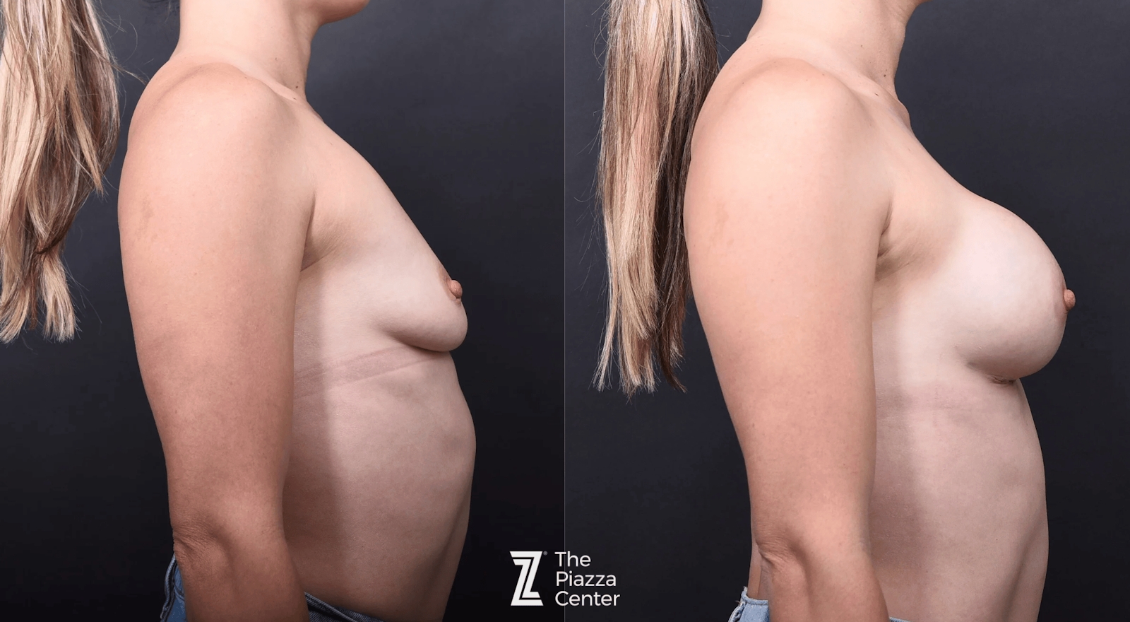 Austin Breast Augmentation Before & After Gallery - Patient 114776 - Image 3 - The Piazza Center