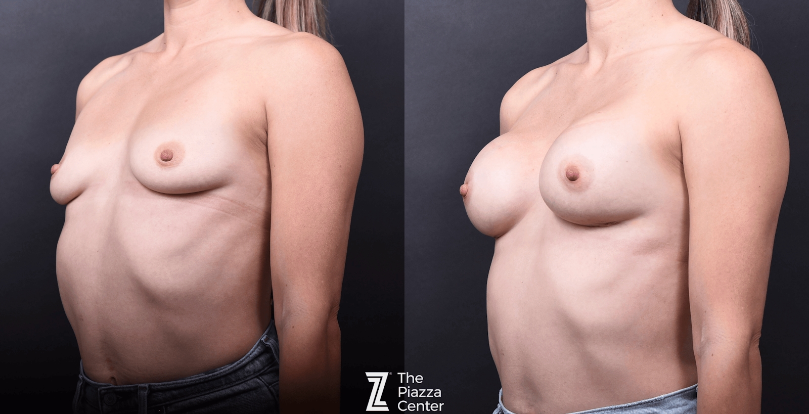Austin Breast Augmentation Before & After Gallery - Patient 114776 - Image 4 - The Piazza Center