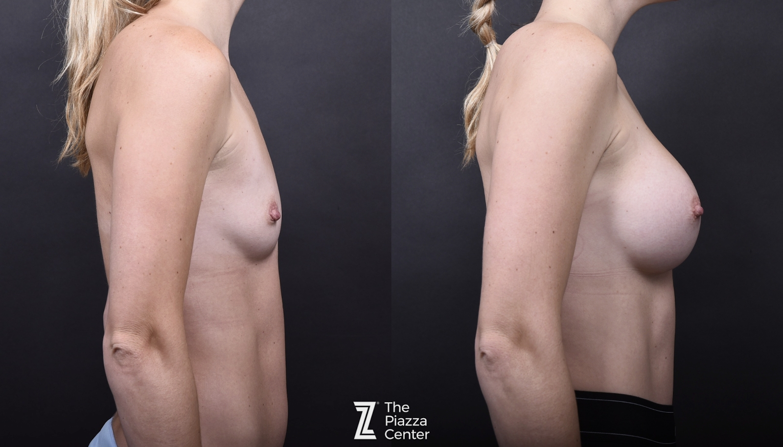Austin Breast Augmentation Before & After Gallery - Patient 133329 - Image 3 - The Piazza Center