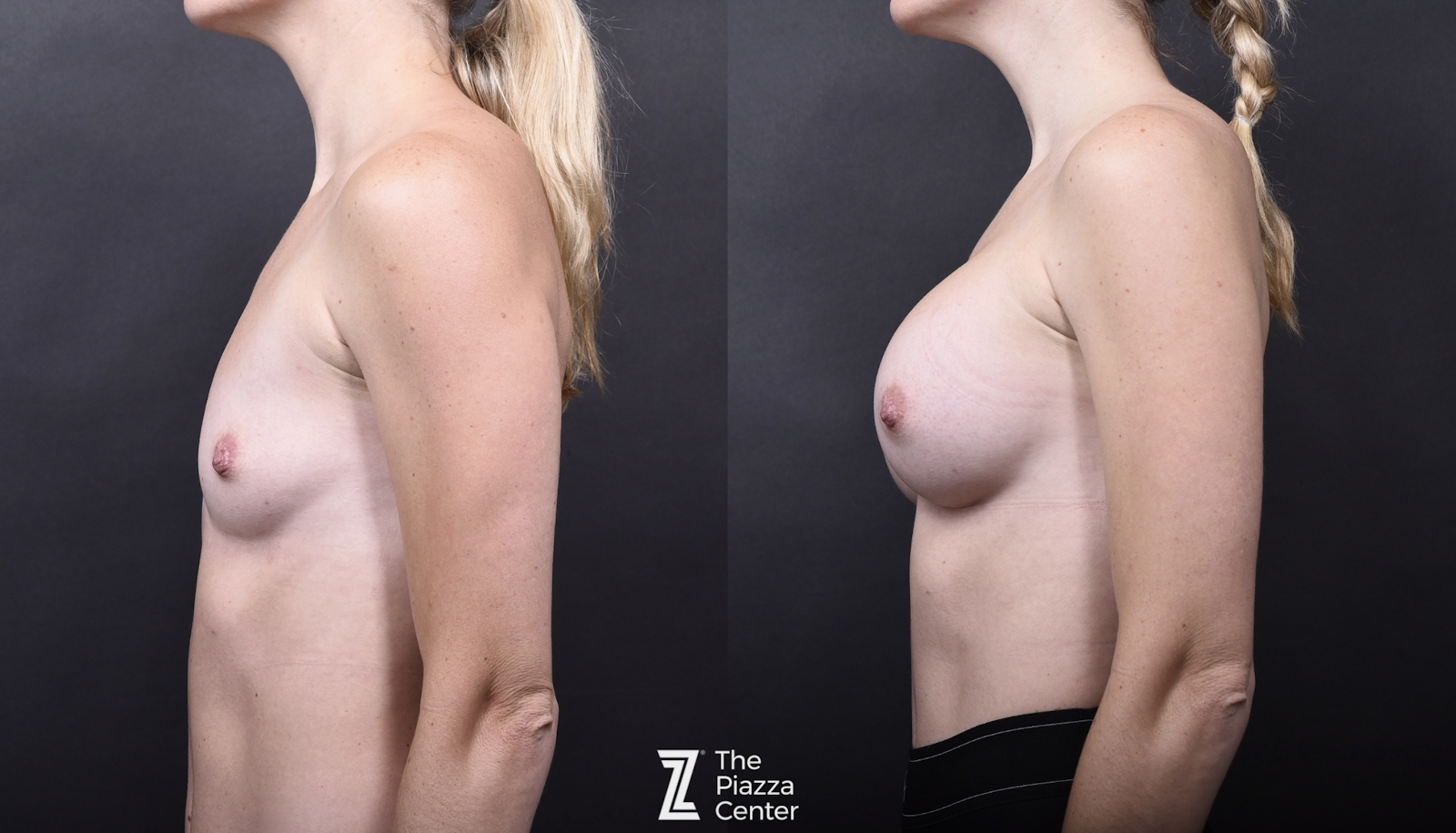 Austin Breast Augmentation Before & After Gallery - Patient 133329 - Image 5 - The Piazza Center