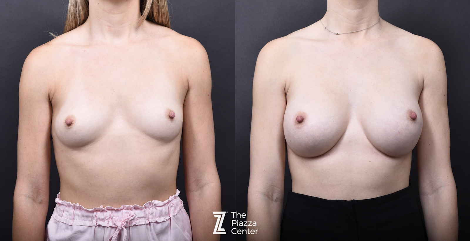 Austin Breast Augmentation Before & After Gallery - Patient 394474 - Image 1 - The Piazza Center
