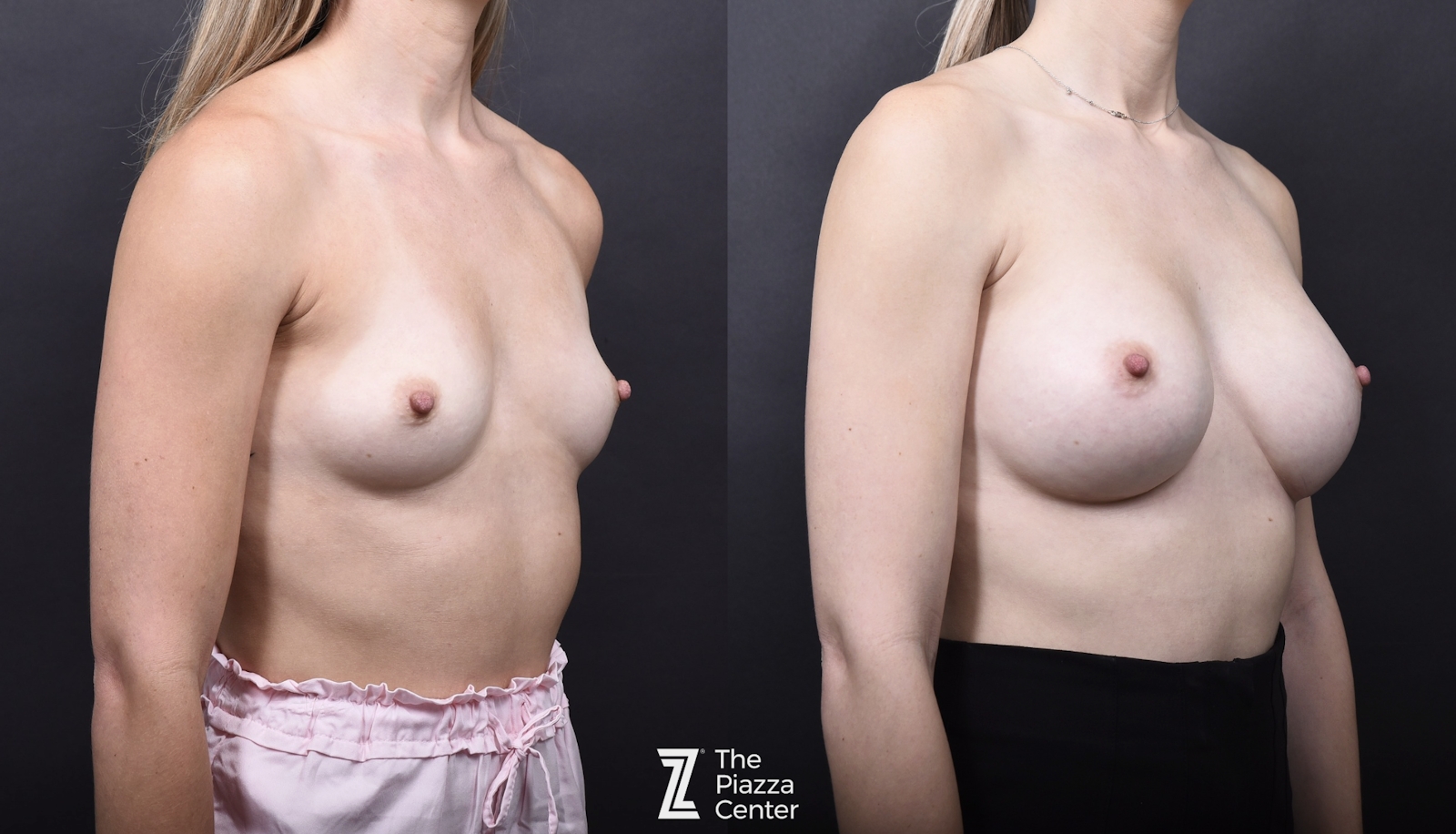 Austin Breast Augmentation Before & After Gallery - Patient 394474 - Image 2 - The Piazza Center