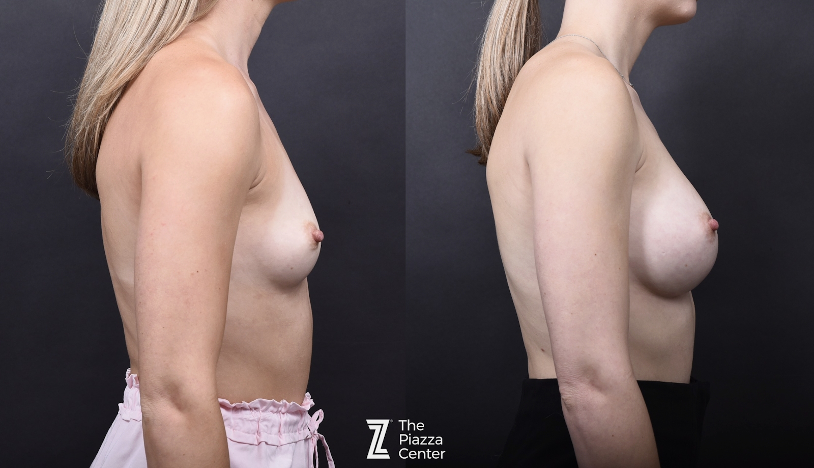 Austin Breast Augmentation Before & After Gallery - Patient 394474 - Image 3 - The Piazza Center