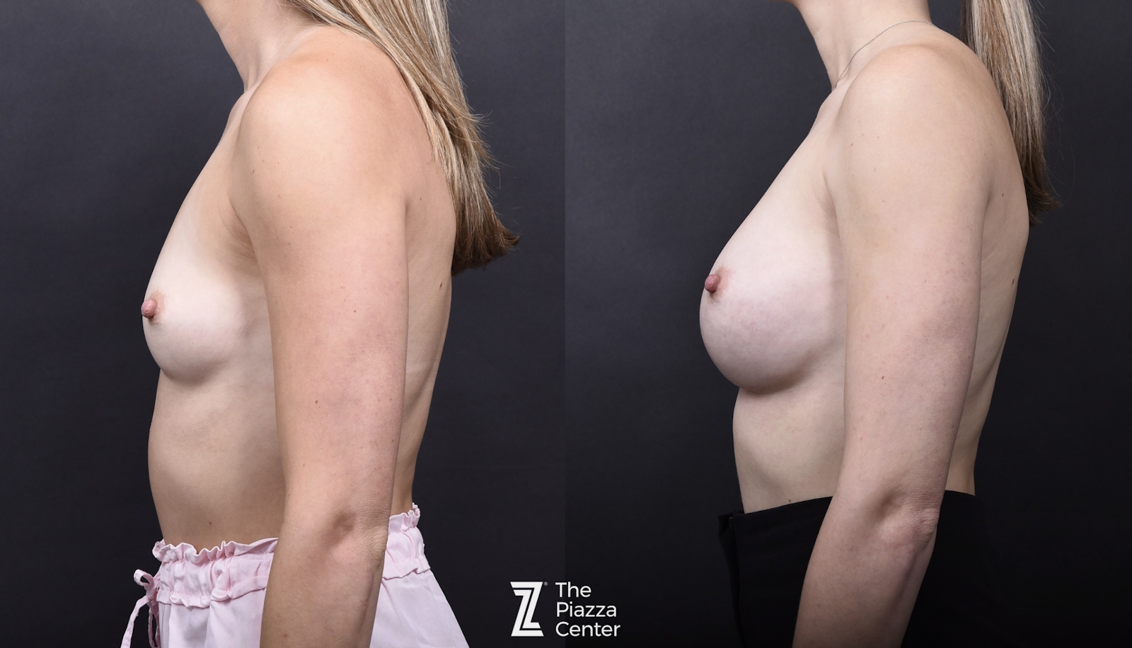 Austin Breast Augmentation Before & After Gallery - Patient 394474 - Image 5 - The Piazza Center