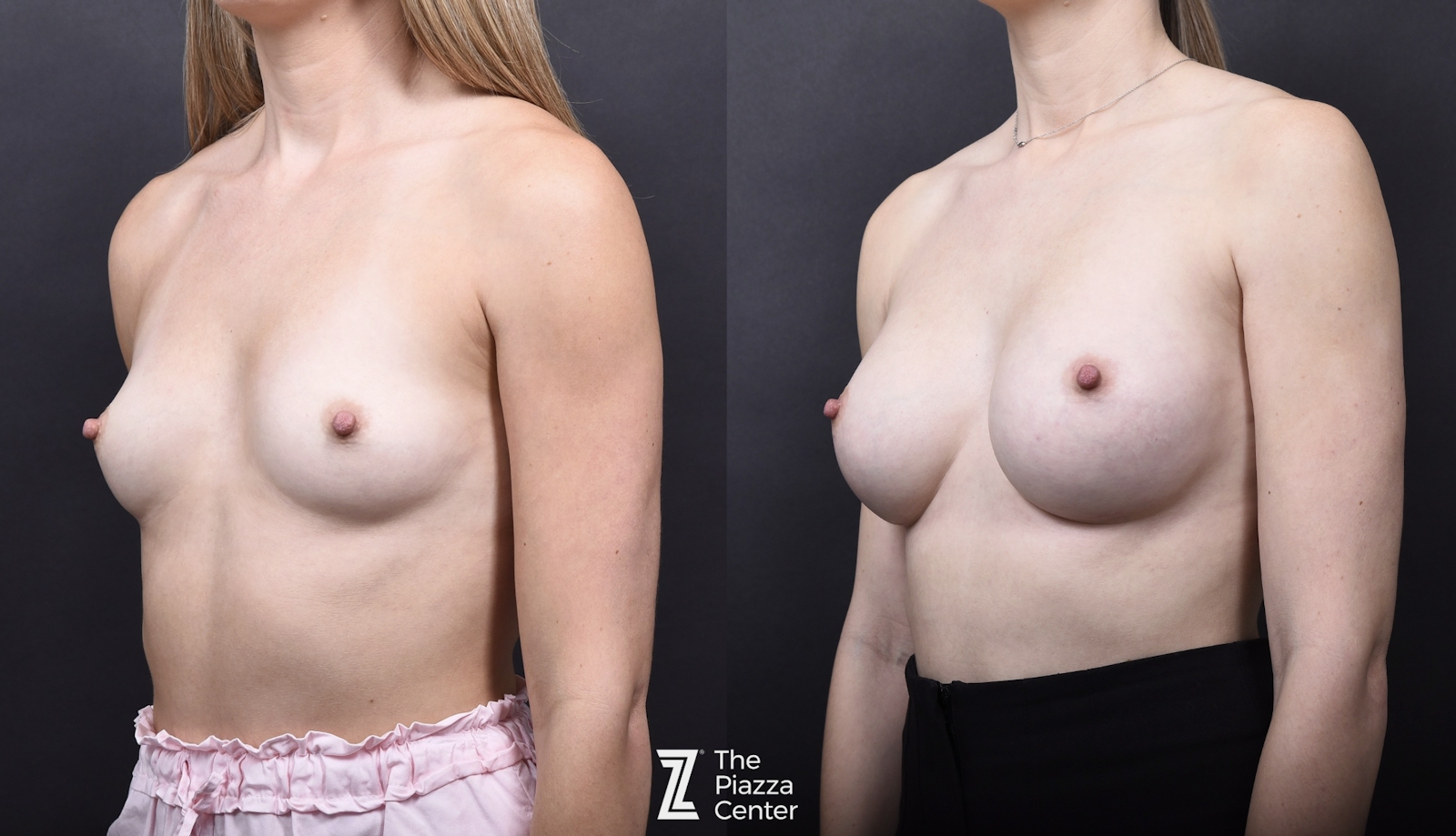 Austin Breast Augmentation Before & After Gallery - Patient 394474 - Image 4 - The Piazza Center