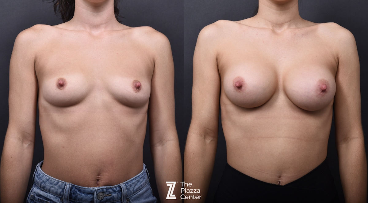 Austin Breast Augmentation Before & After Gallery - Patient 572656 - Image 1 - The Piazza Center