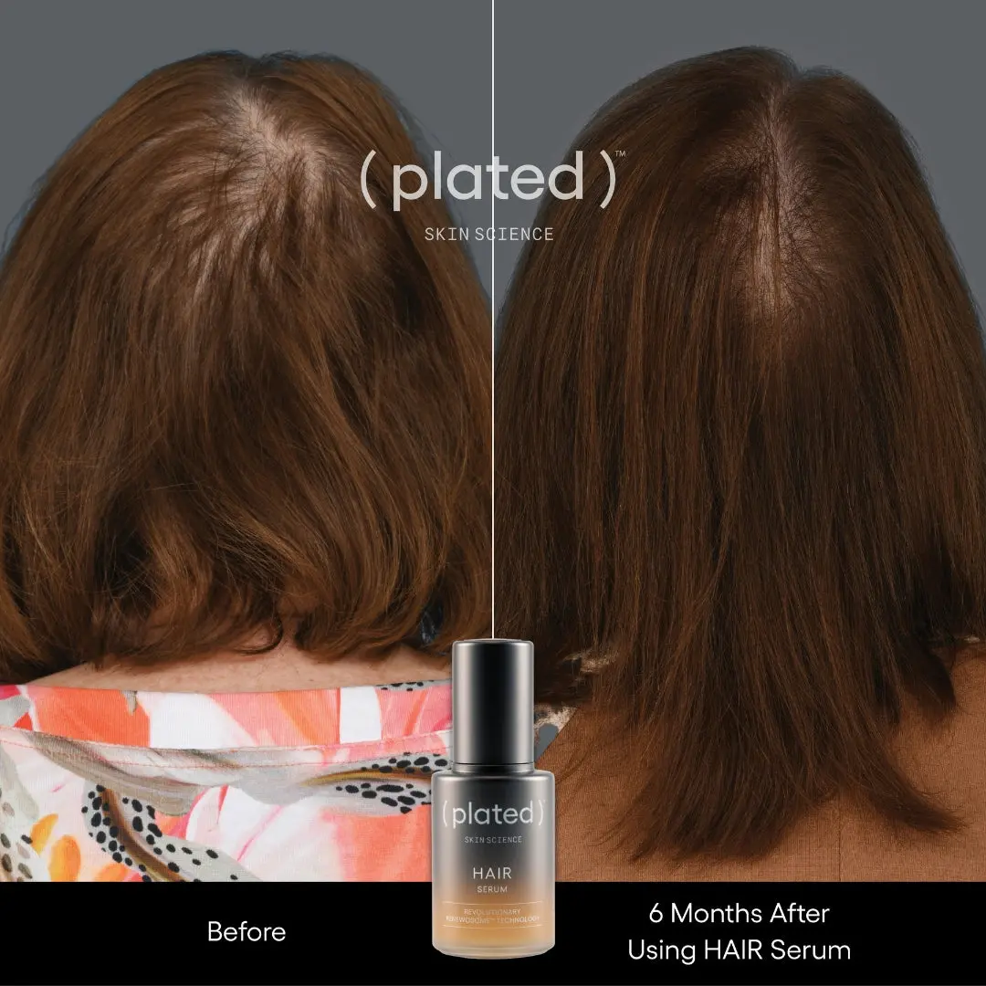 does your hair grow back after glp 1 GLP-1 Weight Loss Injections and Loss GLP1 hope (Tirzepatide) : r/TelogenEffluvium