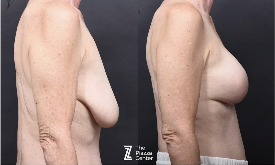 Motiva Preserv&eacute; Before and After Female Patient