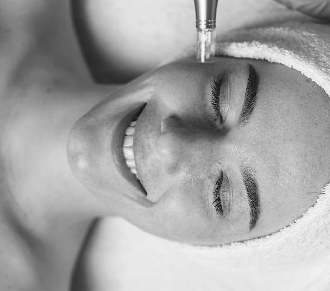black and white photo of a woman getting microneedling