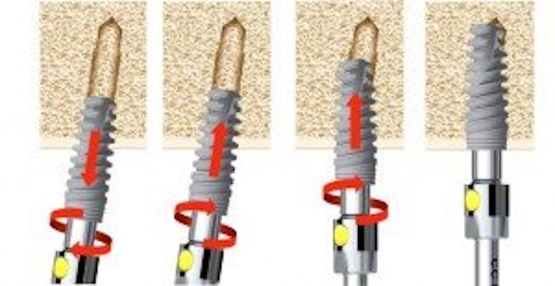 dental implants infographic