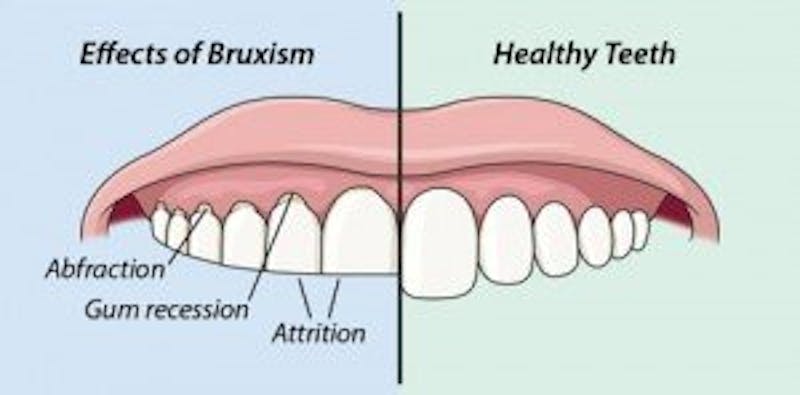 bruxism infrographic