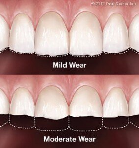 tooth-wear-283x300.jpg