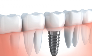 Illustration of a single dental implant replacing a missing tooth