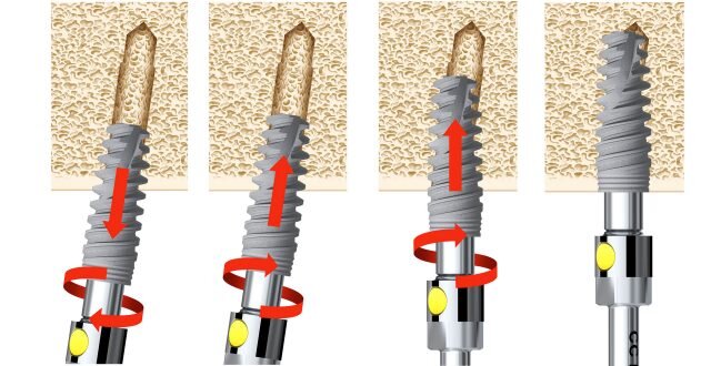 dental implants drawing