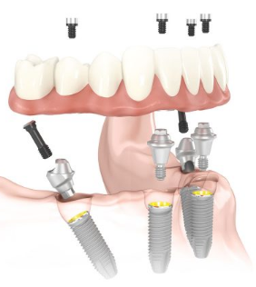 All-on-4 system implants