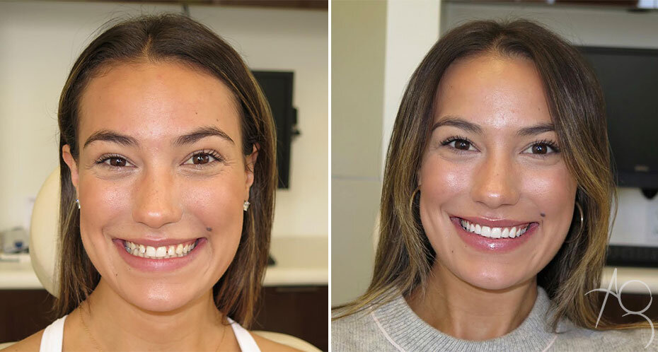 Before &amp; after of one of Dr. Glosman’s happy smile makeover patients