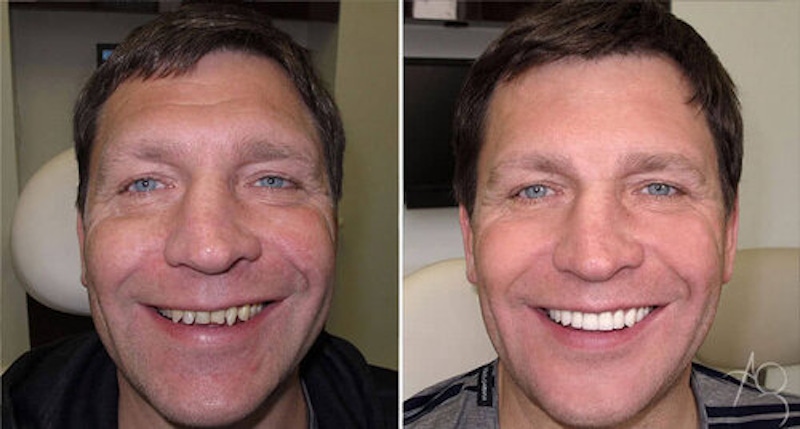 Smile Makeover Before & After Gallery - Patient 167602685 - Image 1