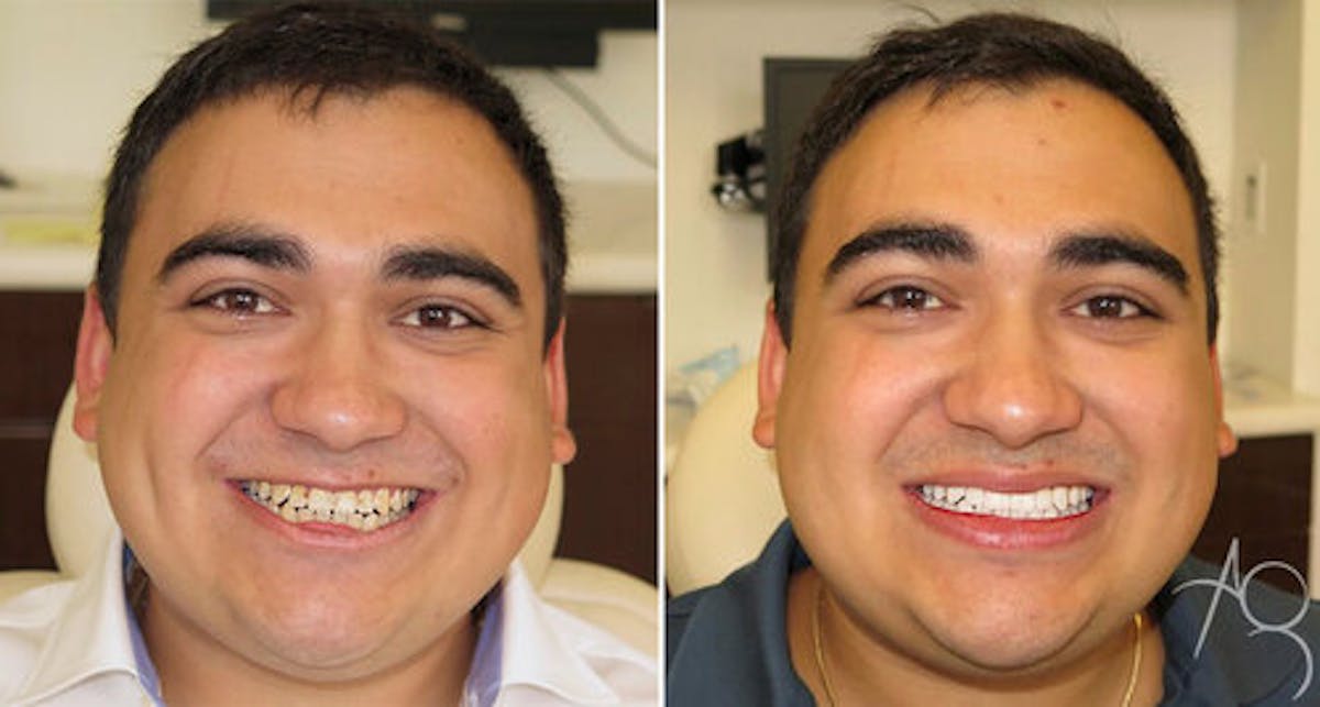 Smile Makeover Before & After Gallery - Patient 167602687 - Image 1
