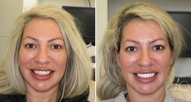 Smile Makeover Before & After Gallery - Patient 167602686 - Image 1