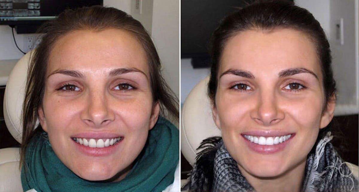 Smile Makeover Before & After Gallery - Patient 167602709 - Image 1