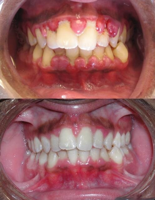 Gingivitis-before-and-after.jpg