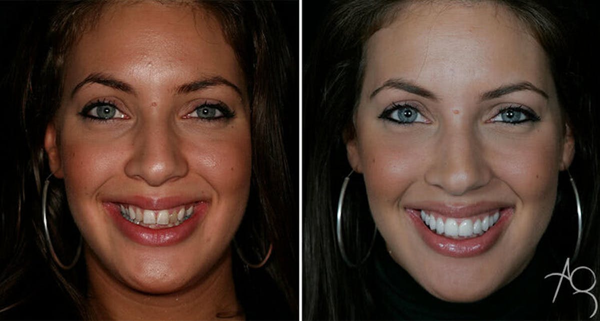 Smile Makeover Before & After Gallery - Patient 167602694 - Image 1