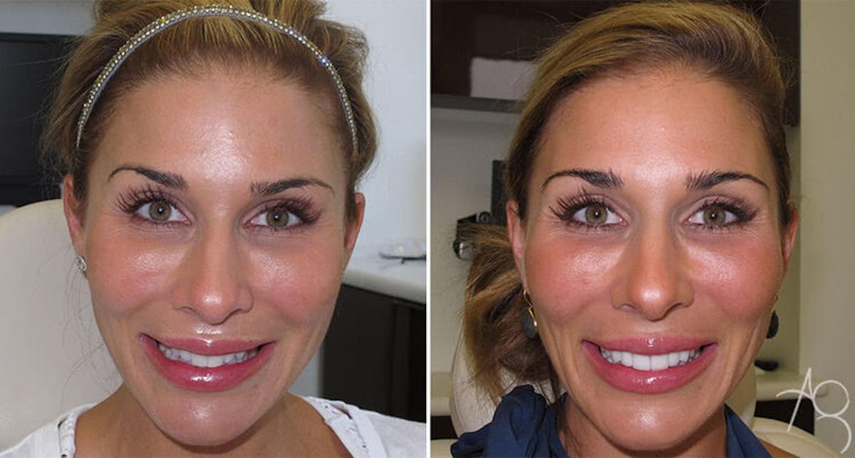 Smile Makeover Before & After Gallery - Patient 167602693 - Image 1