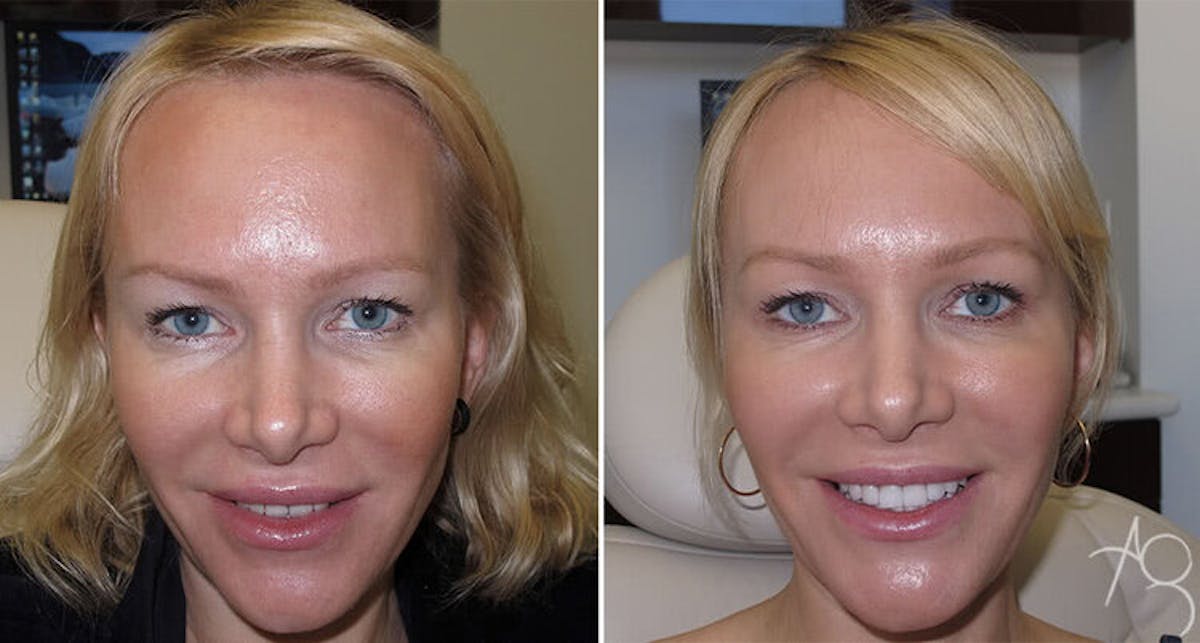 Smile Makeover Before & After Gallery - Patient 167602691 - Image 1