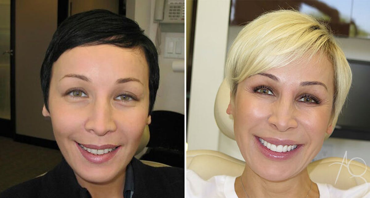 Smile Makeover Before & After Gallery - Patient 167602690 - Image 1