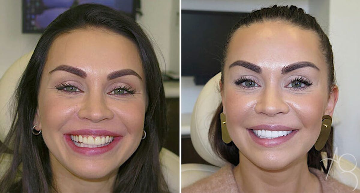 Smile Makeover Before & After Gallery - Patient 167602689 - Image 1