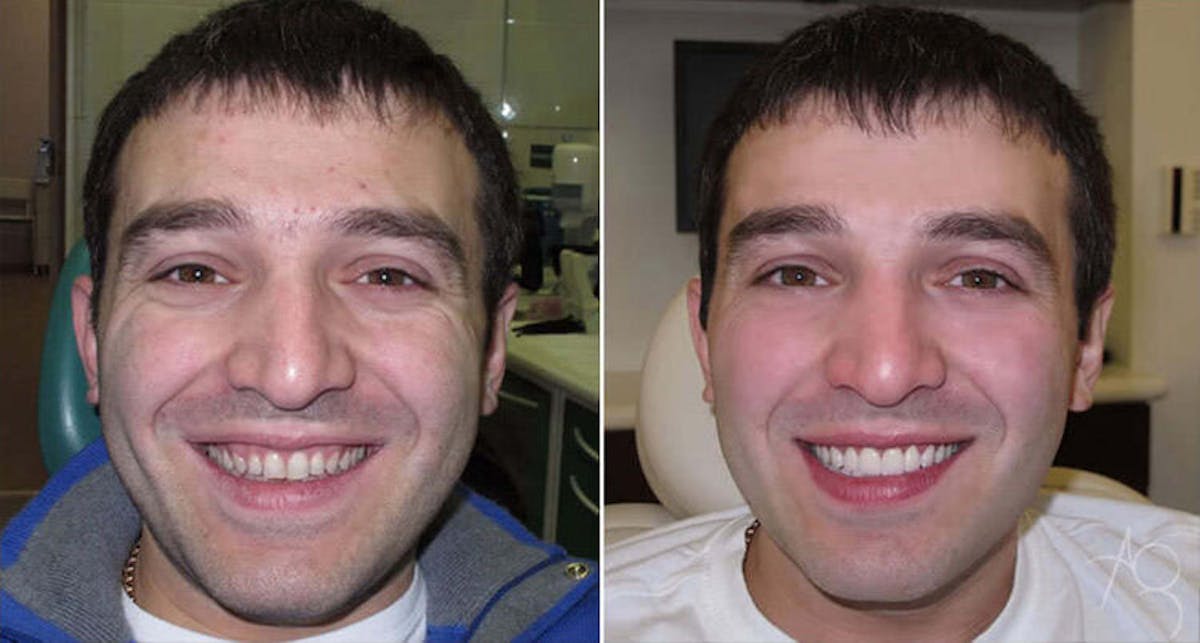 Smile Makeover Before & After Gallery - Patient 167602708 - Image 1