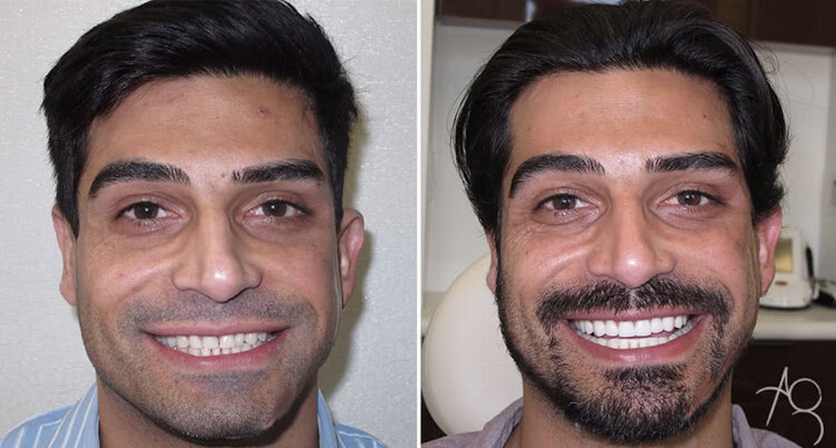 Smile Makeover Before & After Gallery - Patient 167602701 - Image 1