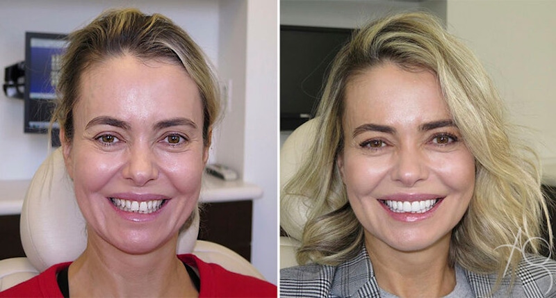 Smile Makeover Before & After Gallery - Patient 167602684 - Image 1