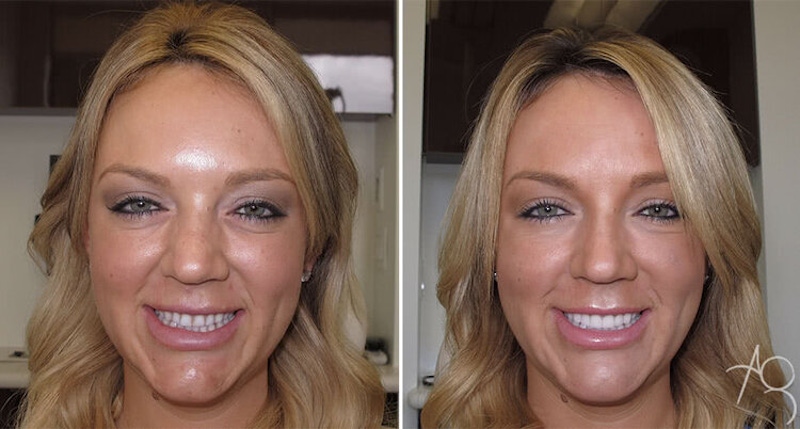 Smile Makeover Before & After Gallery - Patient 167602698 - Image 1