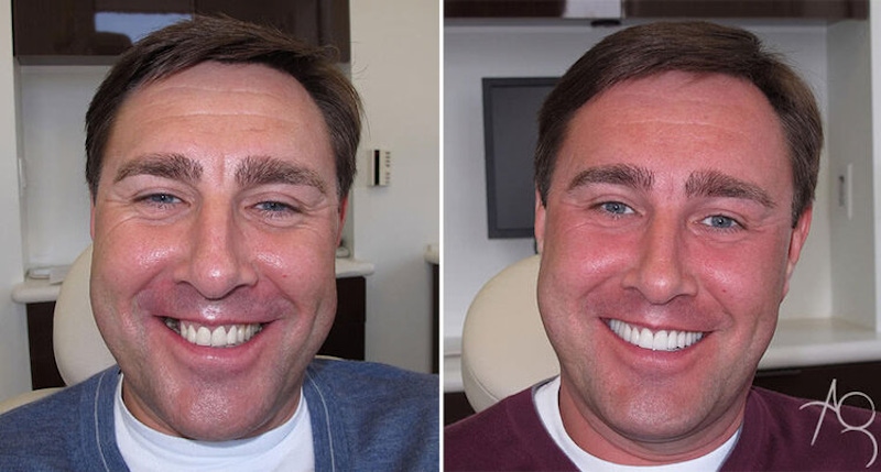 Smile Makeover Before & After Gallery - Patient 167602697 - Image 1