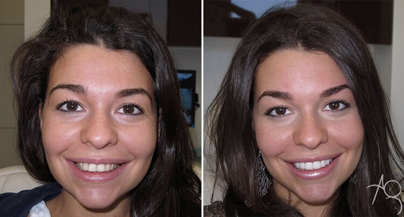 Smile Makeover Before & After Gallery - Patient 167602696 - Image 1