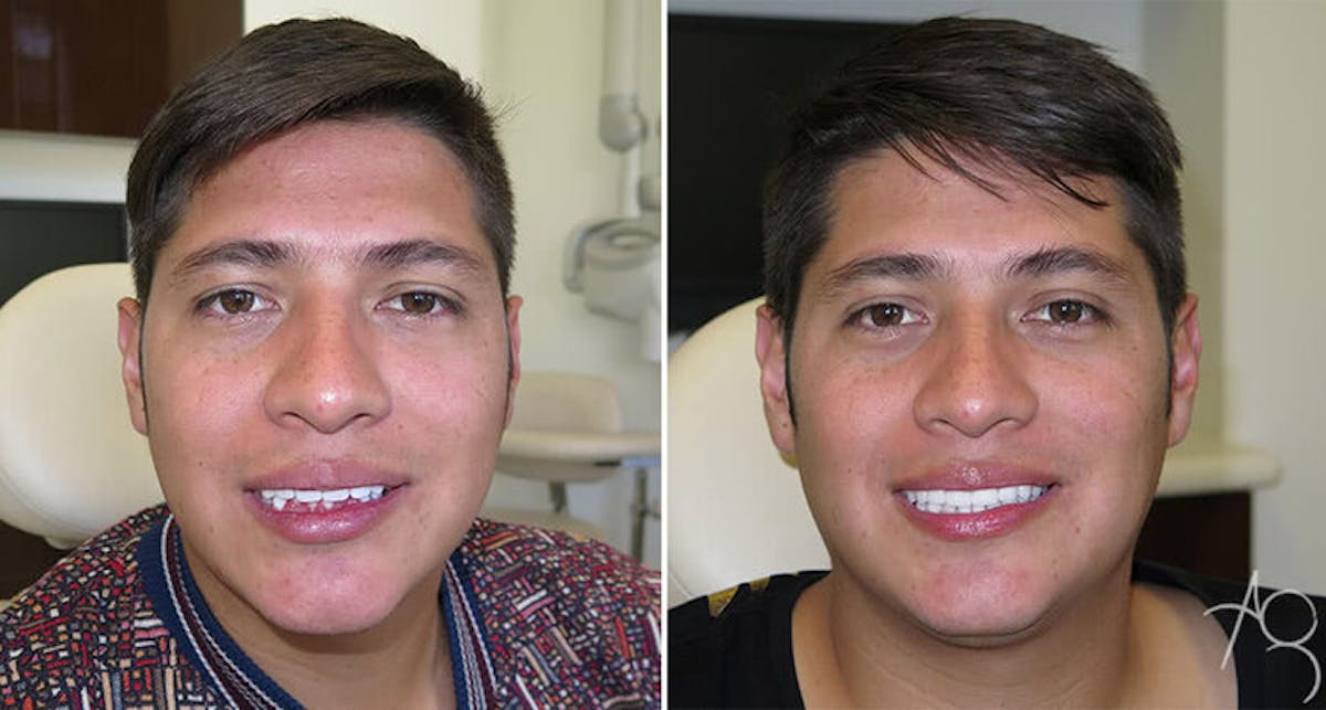 Smile Makeover Before & After Gallery - Patient 167602695 - Image 1