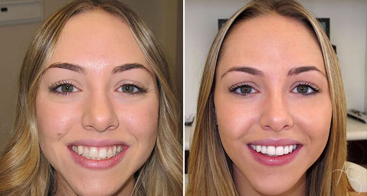 Smile Makeover Before & After Gallery - Patient 167602717 - Image 1