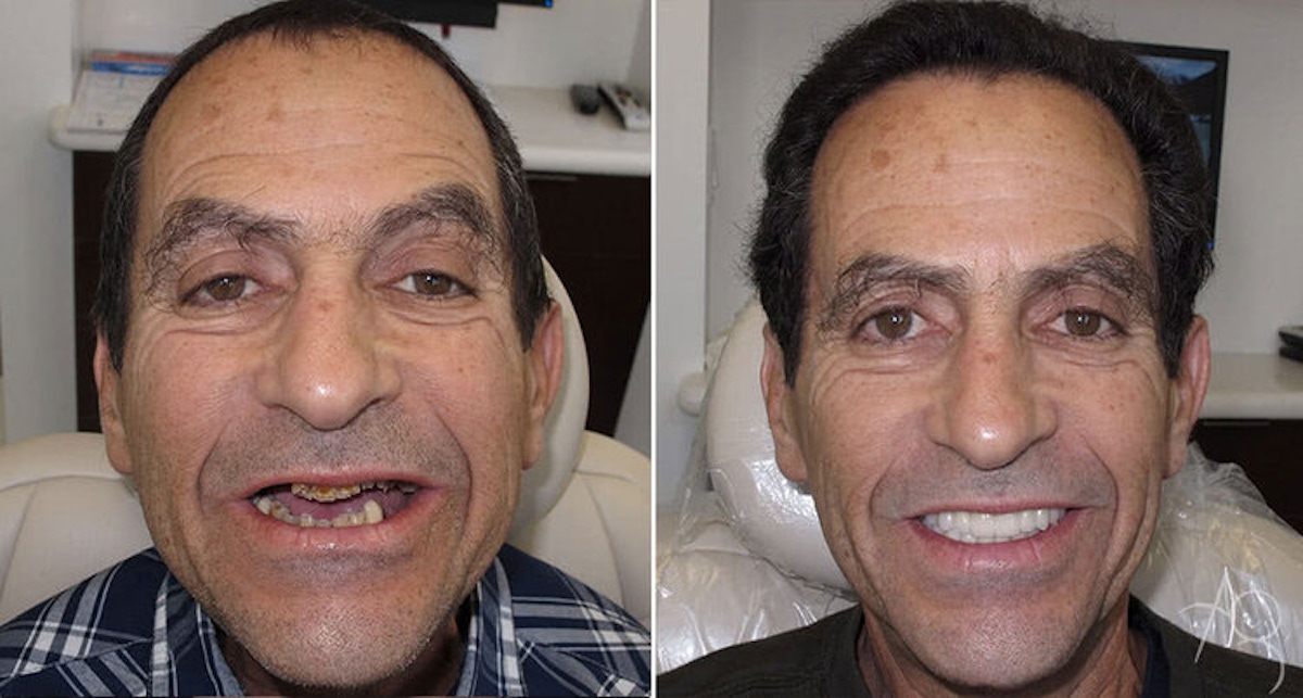 Smile Makeover Before & After Gallery - Patient 167602716 - Image 1