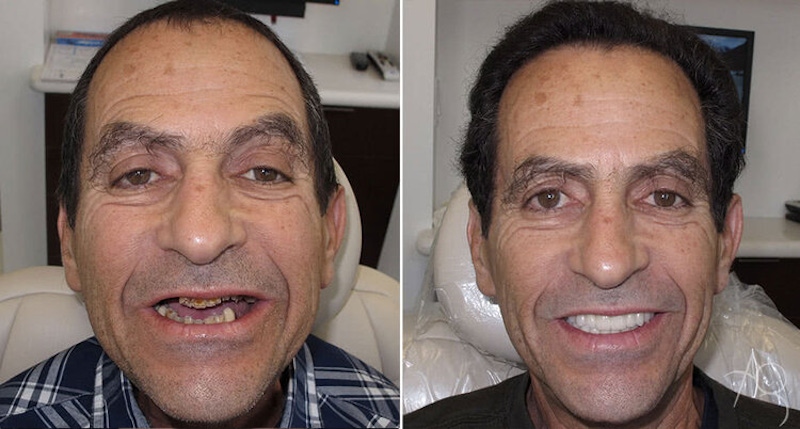 Smile Makeover Before & After Gallery - Patient 167602716 - Image 1