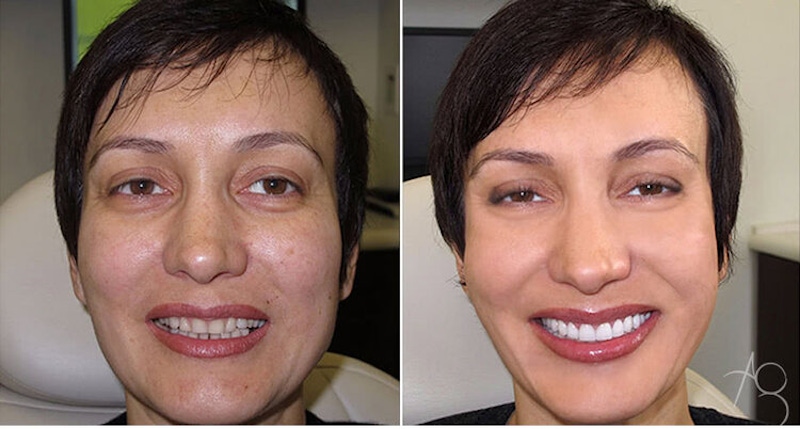 Smile Makeover Before & After Gallery - Patient 167602715 - Image 1