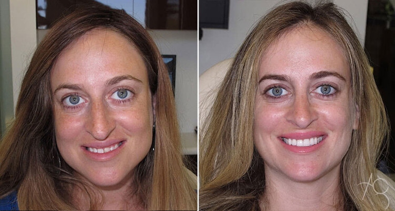 Smile Makeover Before & After Gallery - Patient 167602714 - Image 1