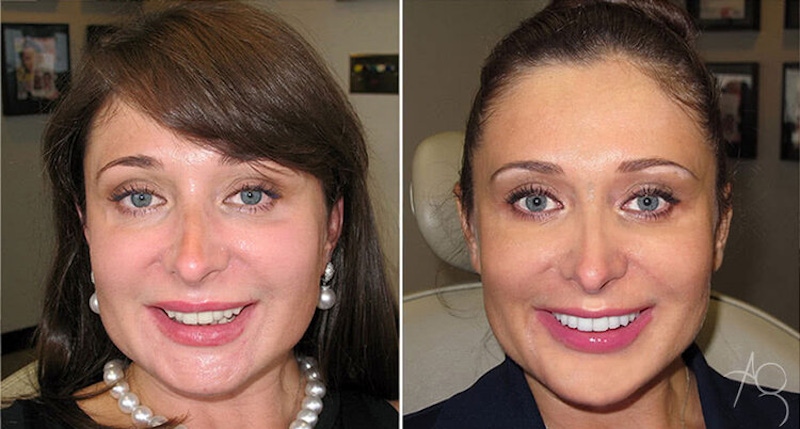 Smile Makeover Before & After Gallery - Patient 167602713 - Image 1