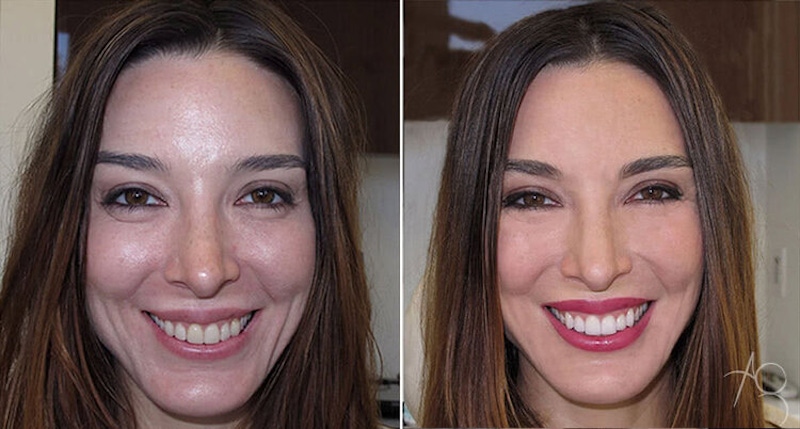 Smile Makeover Before & After Gallery - Patient 167602712 - Image 1