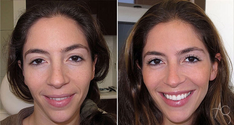 Smile Makeover Before & After Gallery - Patient 167602711 - Image 1