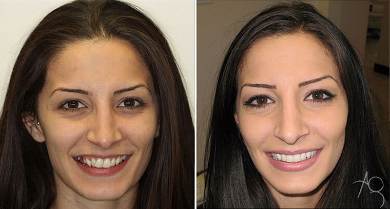 Smile Makeover Before & After Gallery - Patient 167602710 - Image 1